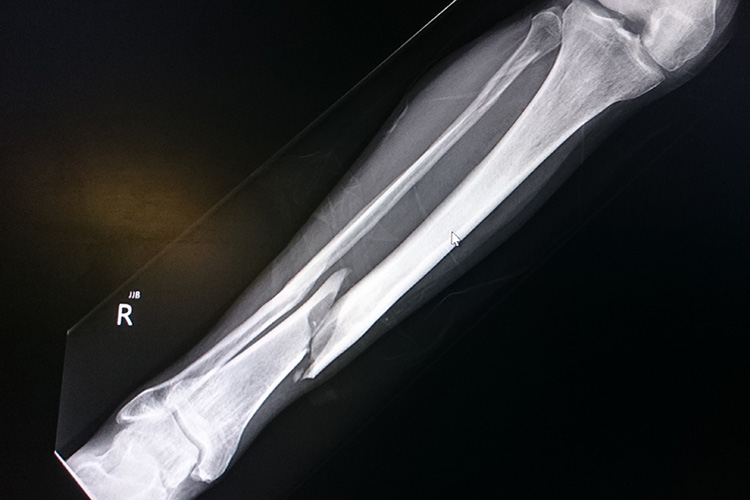 Image of X-ray image of a fractured tibia.